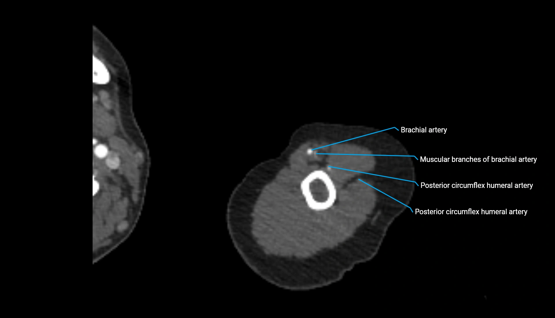 CTA upper limb axial cross sectional anatomy labelled image 298 (2).webp
